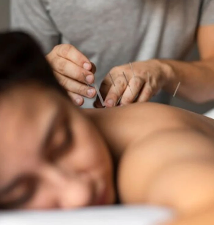Acupuncture and Other Therapies